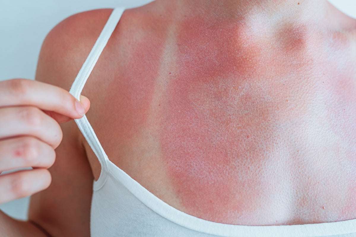 Nahaufnahme des geröteten Dekolletés einer Frau mit sichtbarem Sonnenbrand und hellen Abdrücken eines Trägershirts auf der Haut. Die Haut zeigt typische Reaktionen auf übermäßige UV-Strahlung.